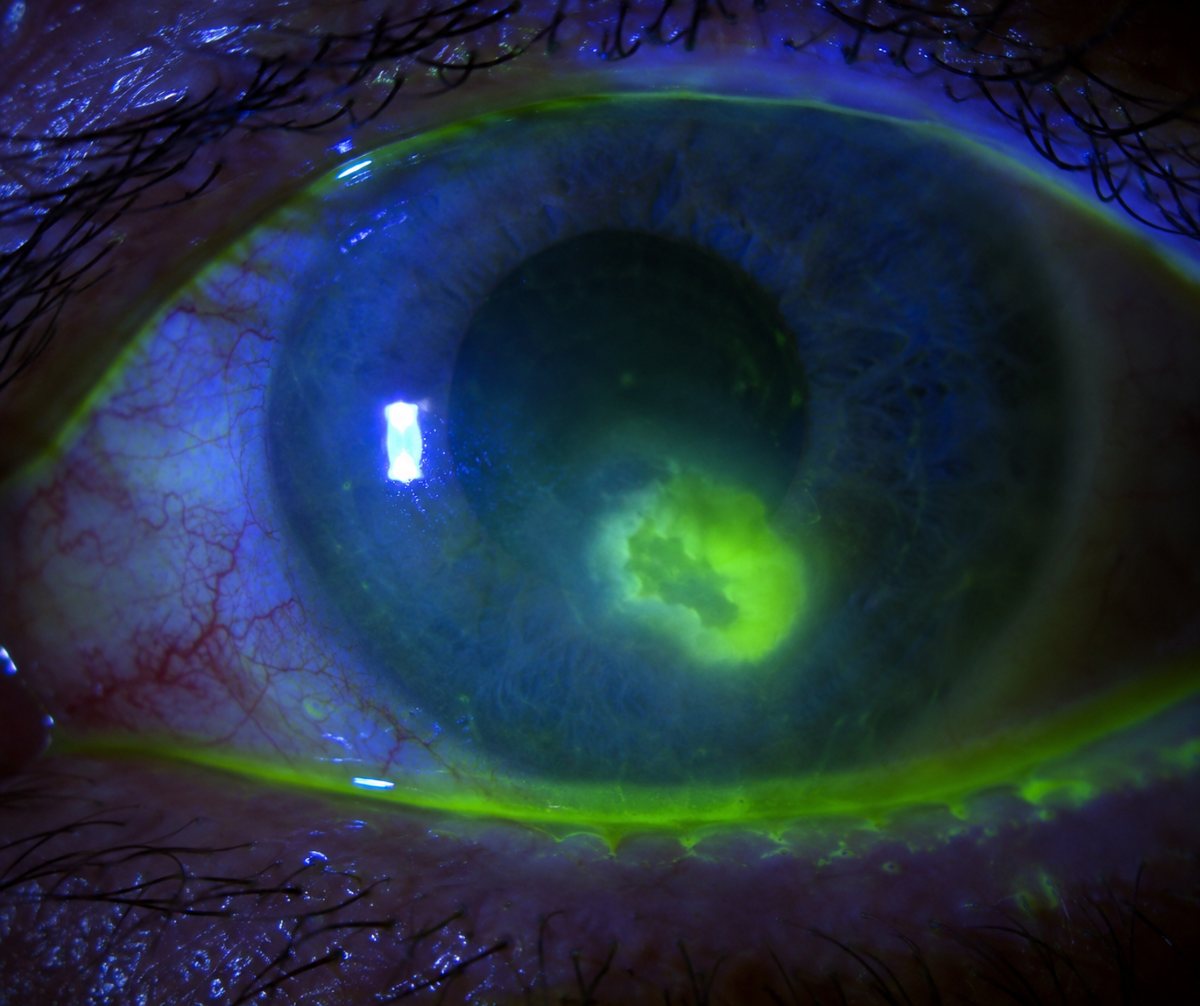 Ulcère de cornée examiné en lumière bleue après fluorescéine : zone vert vif aux contours irréguliers au centre de la cornée, œil rouge