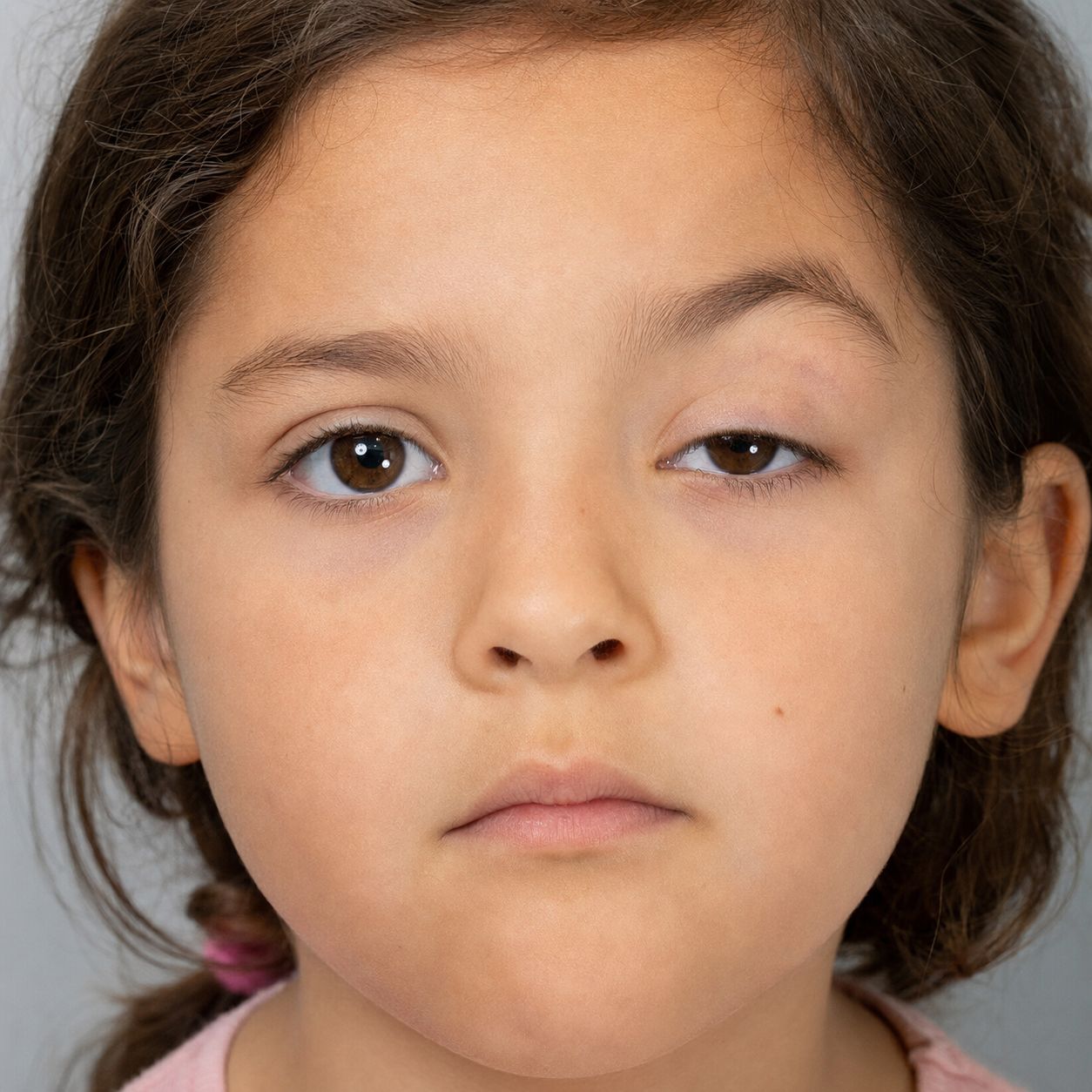 Enfant présentant un ptosis congénital : la paupière supérieure d'un œil retombe et couvre partiellement la pupille
