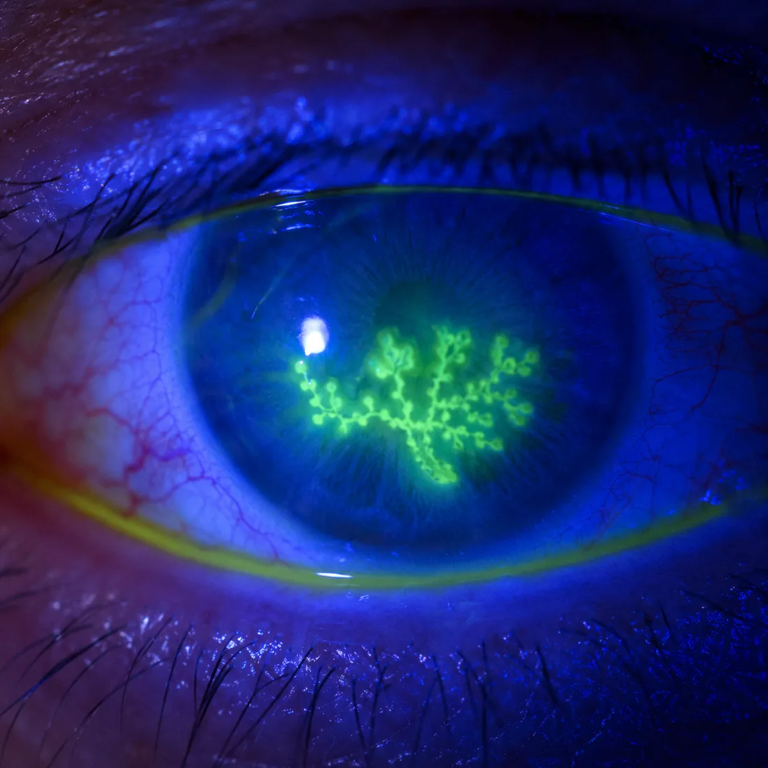 Kératite herpétique : ulcère dendritique en forme de branche d'arbre, coloré en vert par la fluorescéine sous lumière bleue