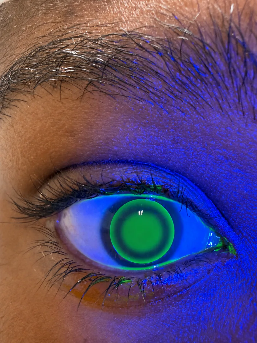 Œil éclairé en lumière bleue : la fluorescéine verte révèle le film de larmes sous une lentille rigide en cours d'adaptation