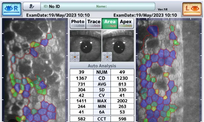Microscopie spéculaire des deux yeux montrant une cornea guttata : les guttae apparaissent comme des trous noirs au sein de la mosaïque des cellules endothéliales, avec une densité cellulaire abaissée