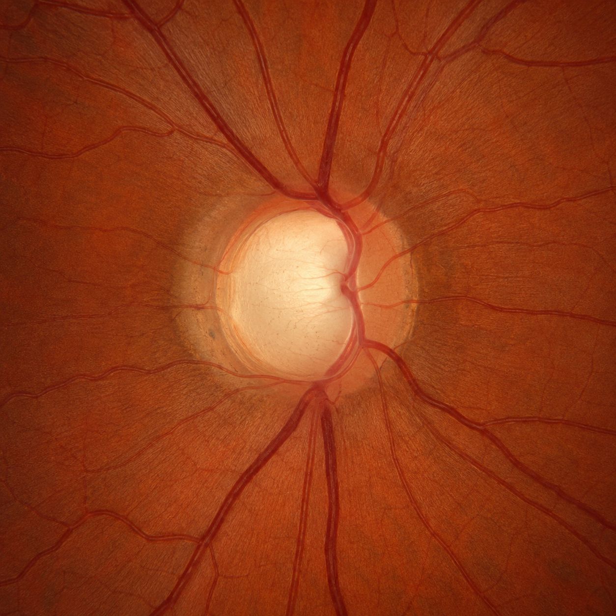 Fond d'œil : nerf optique glaucomateux avec une large excavation centrale pâle et des vaisseaux coudés au bord de la papille