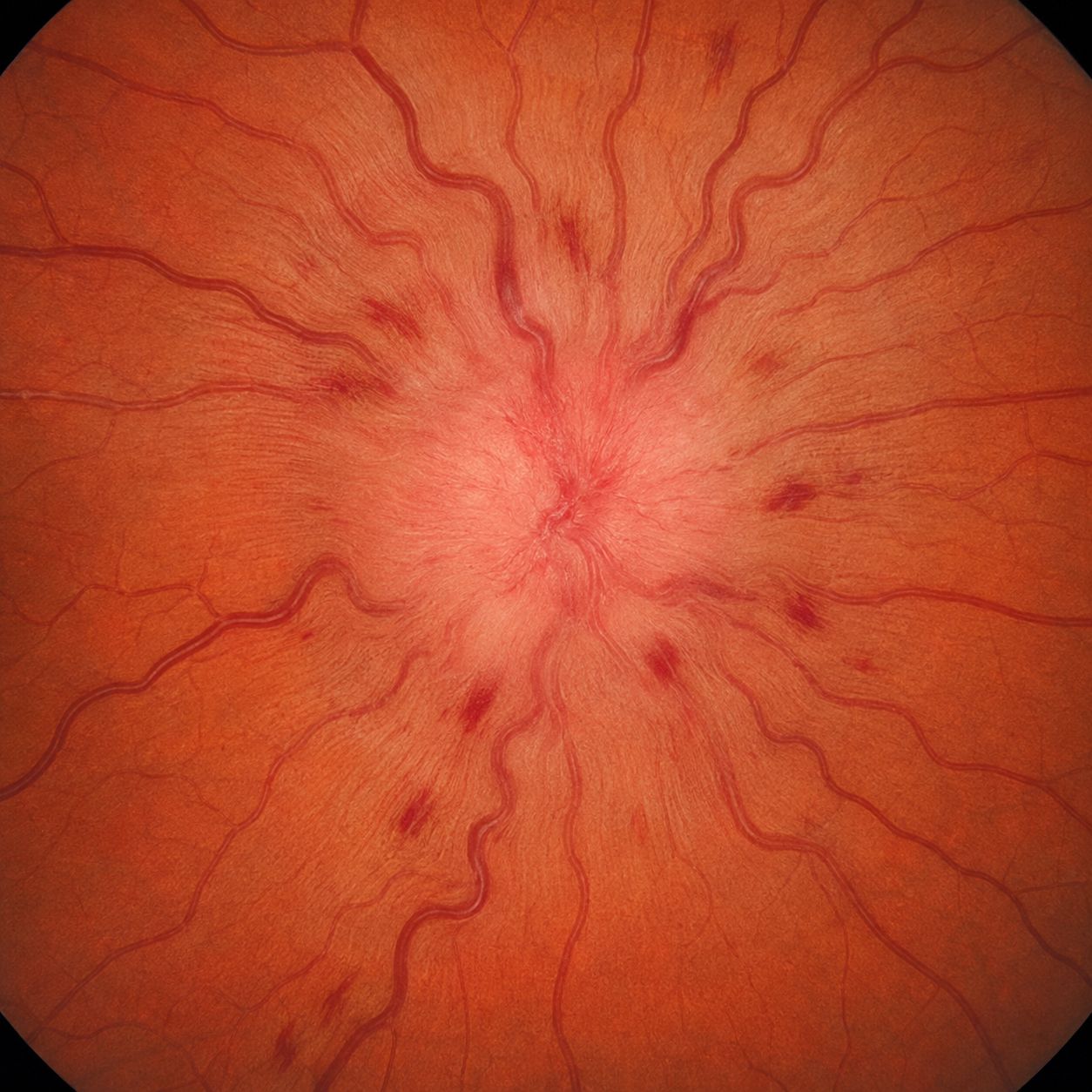 Fond d'œil : tête du nerf optique pâle et œdématiée avec hémorragies en flammèches, évocatrice d'une neuropathie optique ischémique antérieure