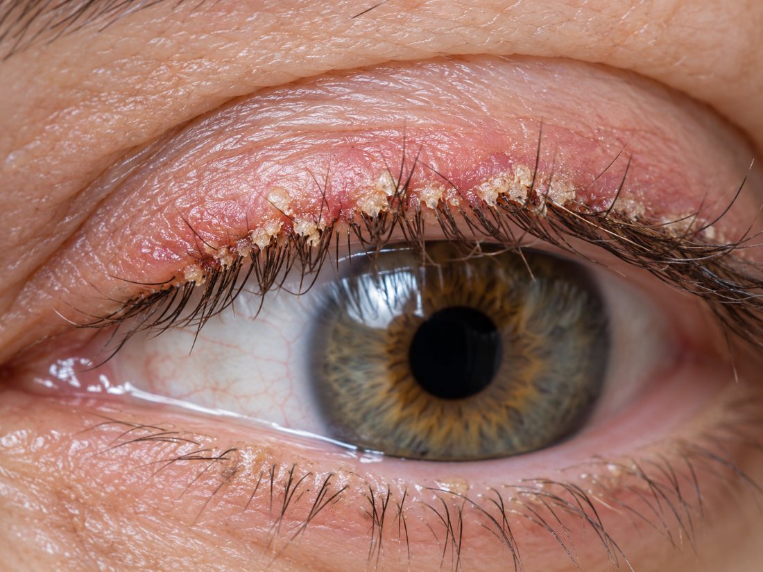 Blépharite à Demodex : bord de la paupière supérieure rouge, avec des manchons blanchâtres engainant la base des cils