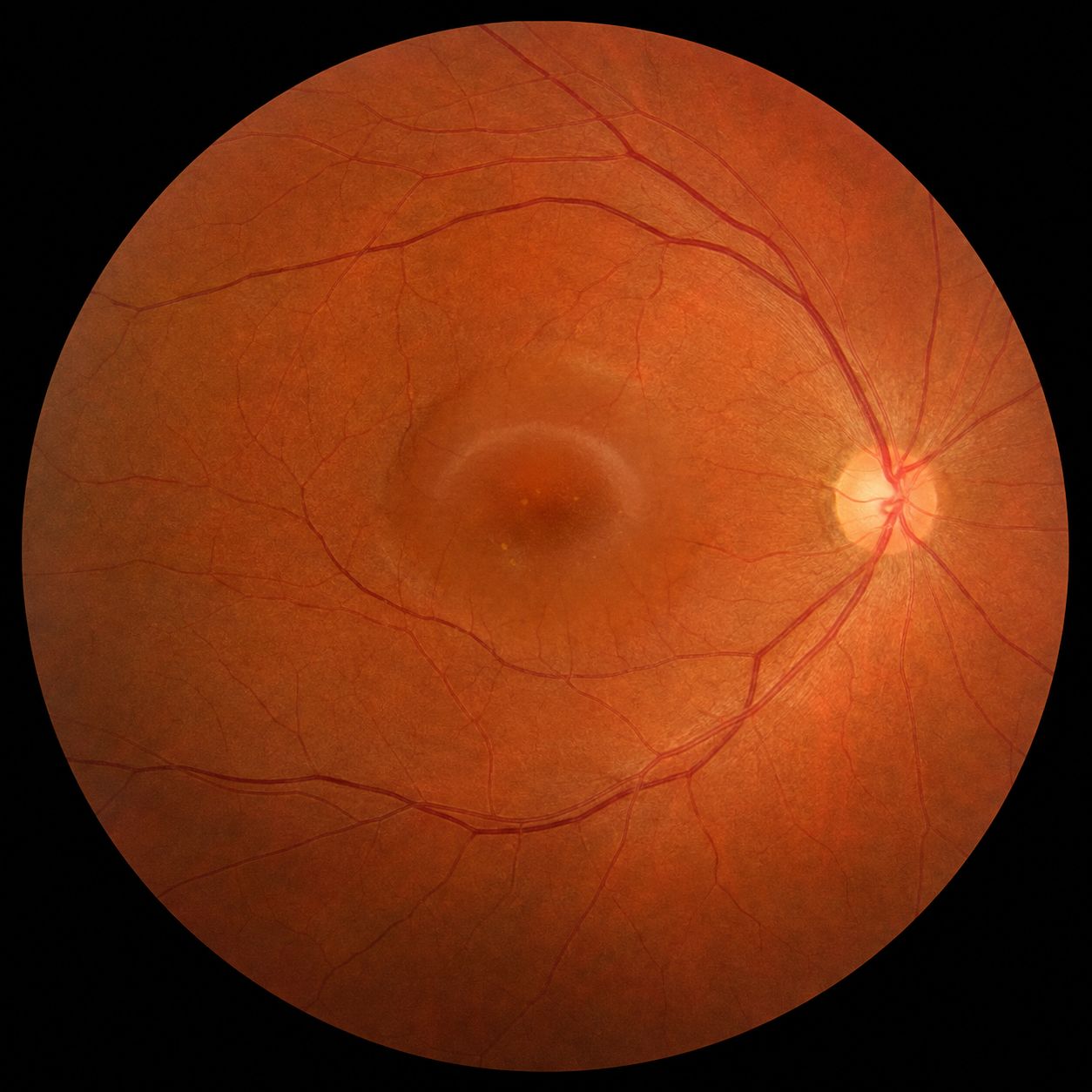 Fond d'œil : soulèvement rond et translucide de la macula par une bulle de liquide séreux, évocateur d'une choriorétinopathie séreuse centrale