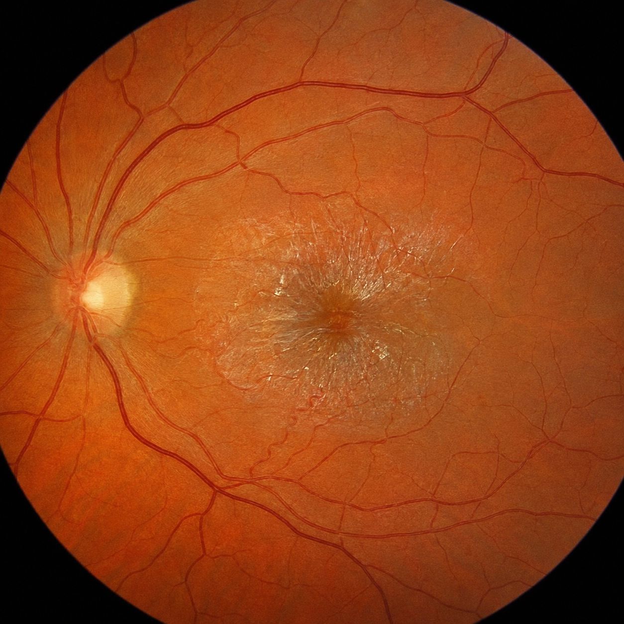 Fond d'œil : macula plissée par une membrane épirétinienne, avec reflet cellophane et vaisseaux tortueux attirés vers le centre