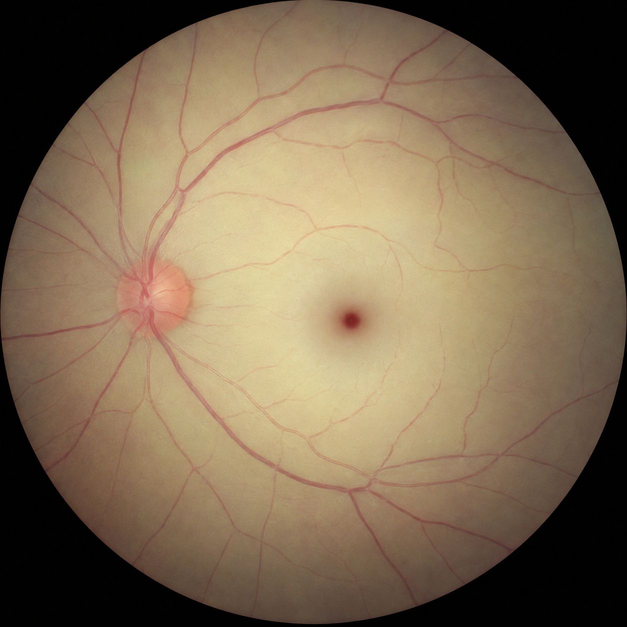 Fond d'œil : rétine pâle et œdématiée laissant apparaître une tache rouge cerise au centre, typique de l'occlusion de l'artère centrale de la rétine