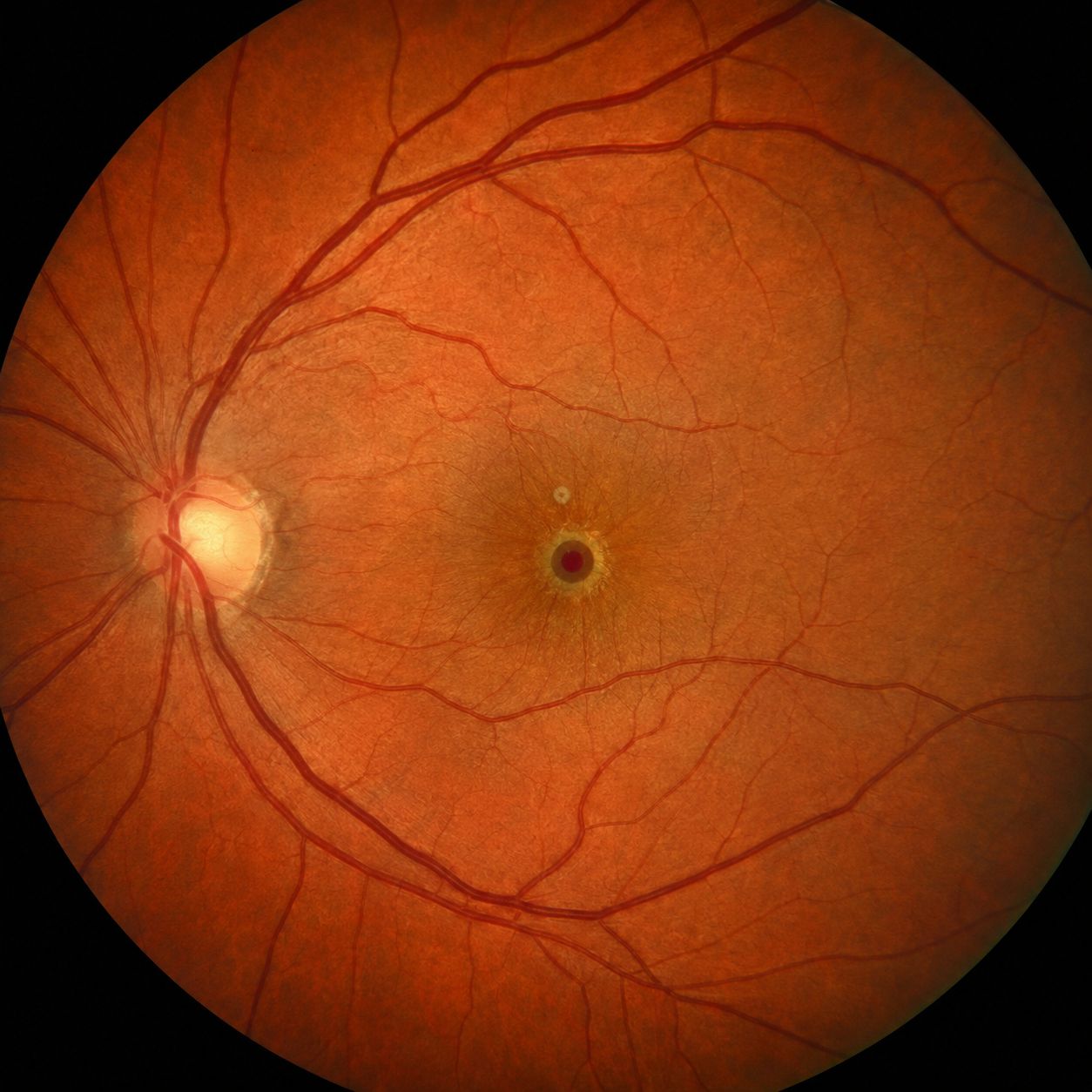 Fond d'œil : petite lésion rouge ronde et bien limitée au centre de la macula, correspondant à un trou maculaire