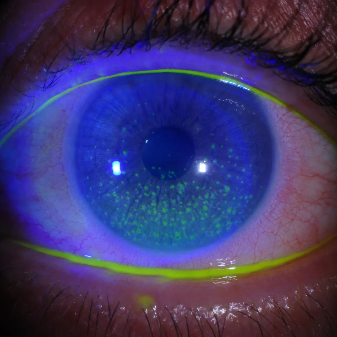 Œil sec examiné à la fluorescéine sous lumière bleue : multiples points verts de kératite ponctuée superficielle
